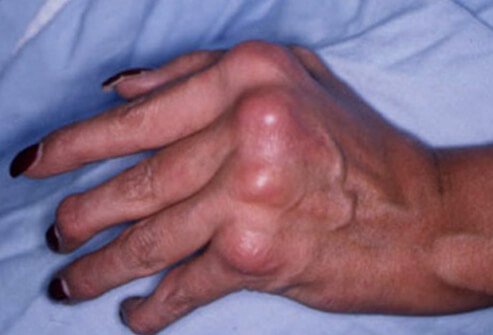 Symmetric psoriatic arthritis affects the same joints on both sides of the body, usually in symmetrical pairs, such as both knees or both wrists.