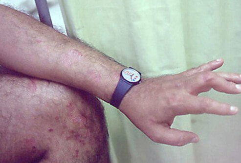 Asymmetric psoriatic arthritis can affect any joint, but usually not in symmetrical pairs on both sides of the body as in symmetric psoriatic arthritis.