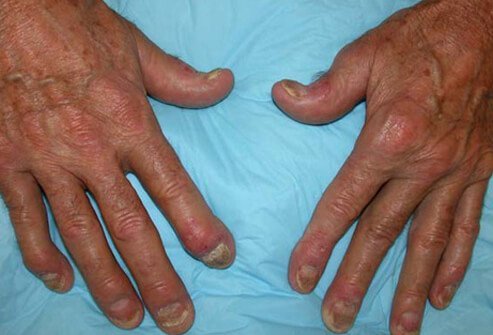 Distal interphalangeal predominant (DIP) psoriatic arthritis is often confused with osteoarthritis.