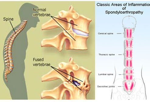Spondylitis is inflammation of the spinal column and it may cause stiffness in the neck, lower back, spinal vertebrae, or sacroiliac region (pelvic area).