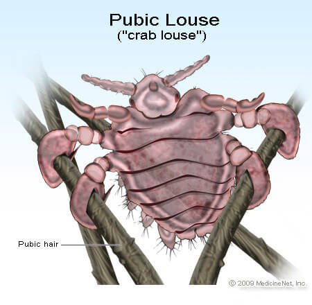 Picture of pubic louse (crab)