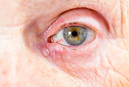 A 3-snip procedure is one of the techniques to treat watery eyes or excessive tears in the eye.