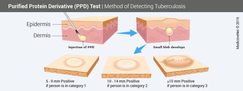 Purified Protein Derivative (PPD) Test