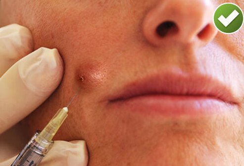 For large acne cysts, corticosteroid injections may offer a quick fix.