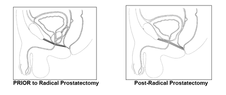 Picture of a radical prostatectomy