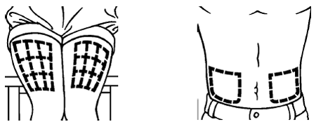 Injection site - Illustration 1