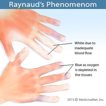 An illustration describes Raynaud's phenomenon.