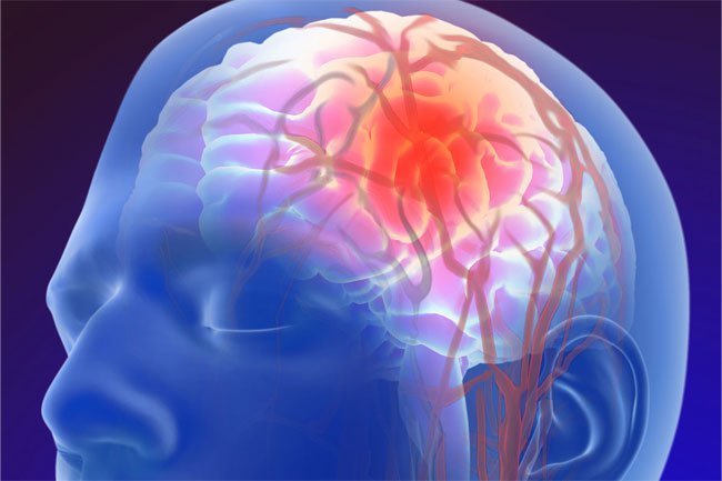 A stroke may cause your eyelid to droop, so seek immediate medical attention.