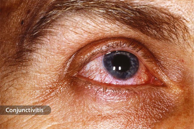 If you have pinkeye or a stye, it may cause your eye to swell and your eyelid to droop.