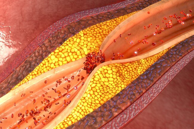Plaque builds up in your arteries and slows blood flow to your brain and other organs.