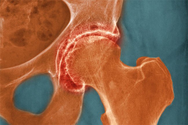 Osteoarthritis causes stiffness and pain.