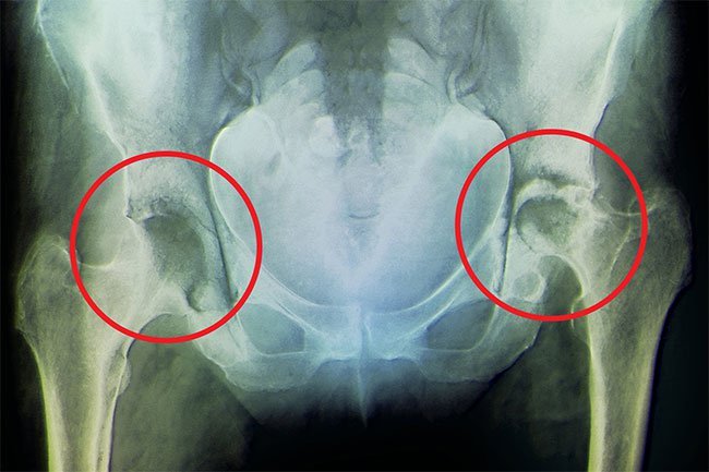 Rheumatoid arthritis is an autoimmune disease that attacks the joints.