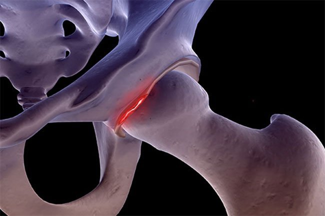 People who play certain sports are more likely to suffer a labral tear.