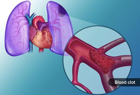 A pulmonary embolism may lead to life-threatening lung problems.