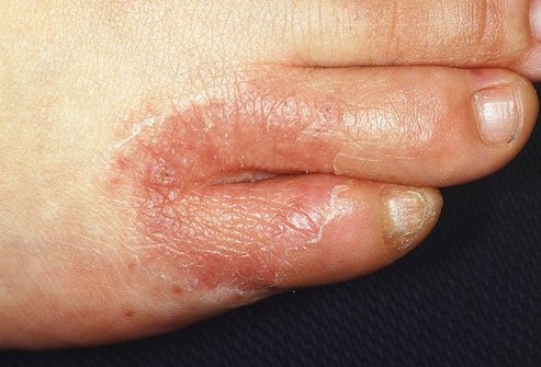 It's a mold-like fungus that grows in warm, moist areas between your toes and on the bottom of your feet.