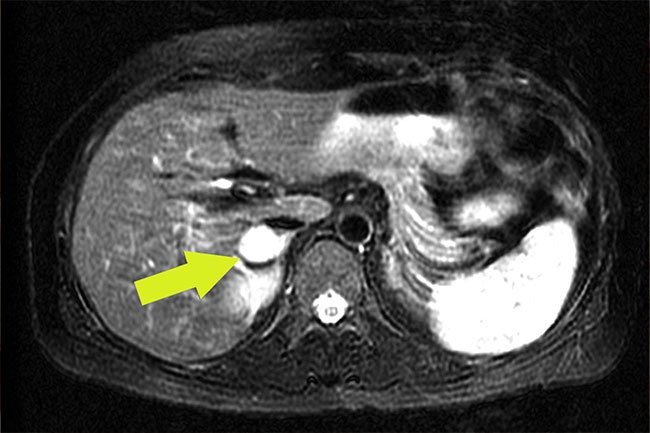 Pheochromocytoma is a rare tumor that causes shaking, sweating, high blood pressure, shortness of breath, and headaches.