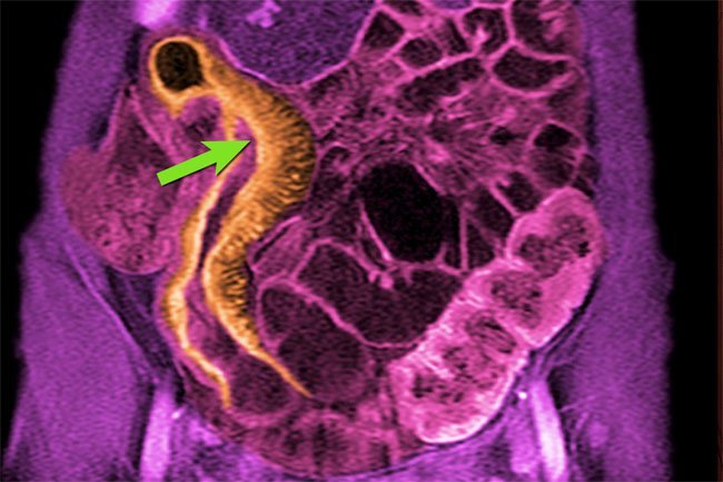 Inflammatory Bowel Disease (IBD), in this condition, the immune system seems to overreact and inflame your intestinal tract. 