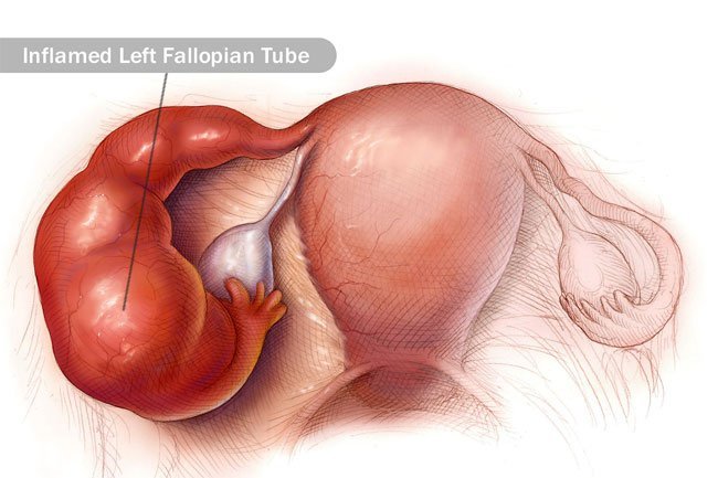 Pelvic inflammatory disease may happen to women.