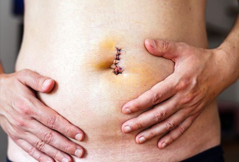 An umbilical hernia repair is a relatively routine surgery and takes about 20 to 30 minutes. It can be performed as an open surgery or a minimally invasive laparoscopic surgery. An open surgery might require two to three days of hospitalization, but with a laparoscopic surgery a patient may be able to go home the same day or after 24 hours.