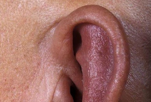 Redness and swelling of the ears is a common sign of relapsing polychondritis.