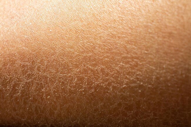 It's normal for retinoids to cause dry skin, redness, itching, or flaking.