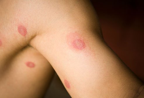 Ringworm is a highly contagious fungal infection.