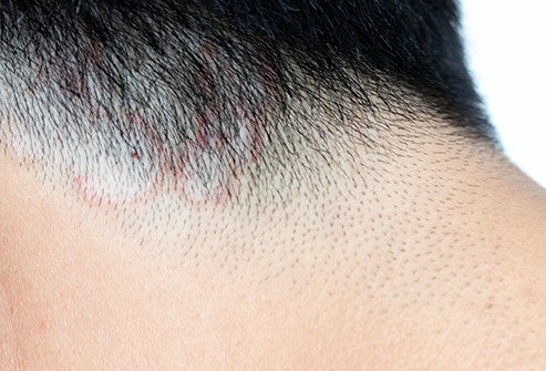 You should seek medical attention if you suspect you or your child has ringworm on the scalp. Ringworm on the scalp can only be treated with prescription medication.