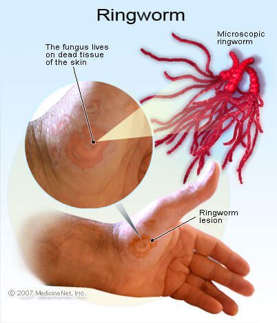 Pictures of Ringworm (Tinea)