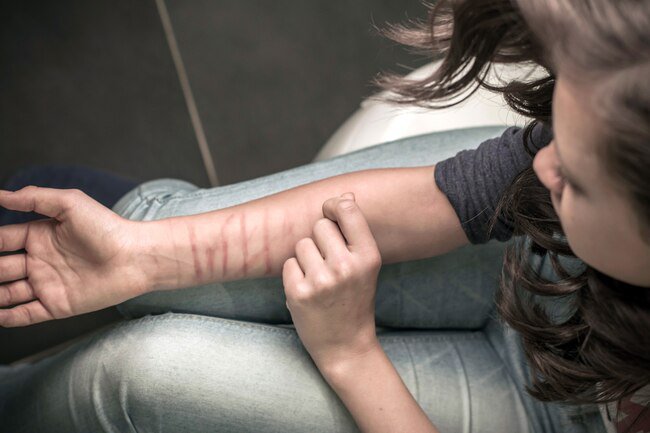 Self-harm is a coping mechanism for traumatic memories and mental pain.