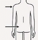 Choose needle based on injection location (gluteal or deltoid) - Illustration