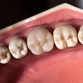 A crown is often placed on the tooth after a root canal to help prevent the tooth from fracture.
