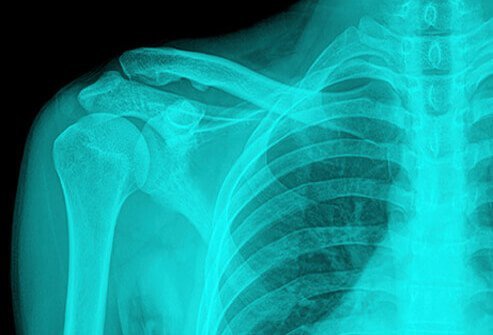A Rotator Cuff Injury