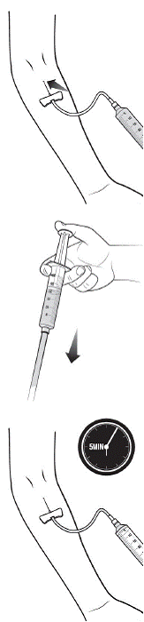 Prepare the approved IV injection site - Illustration