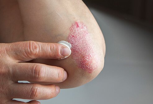 Proriasis Treatment