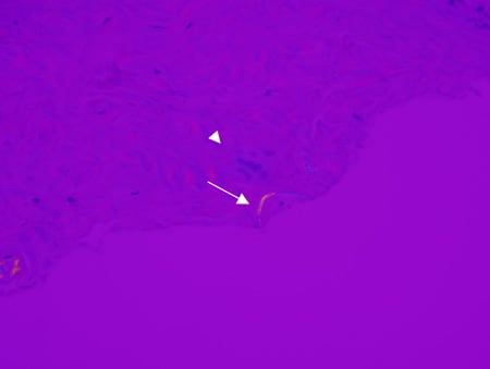 Pathology photo showing thorn material (blue and yellow birefringent material) visualized under polarized light microscopy.