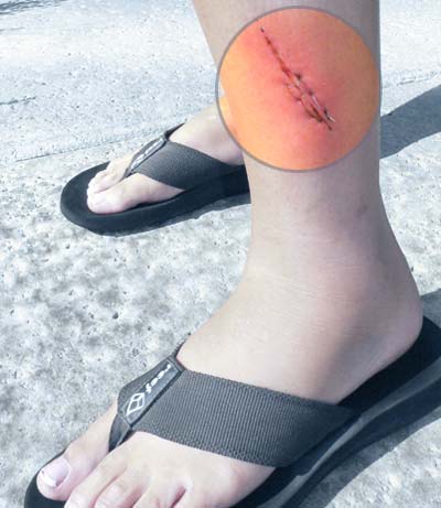 A picture of stitches or sutures
