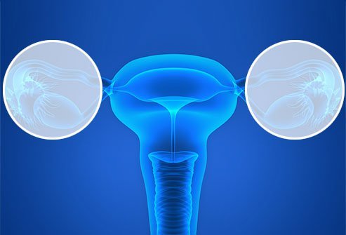 Salpingo-oophorectomy is the procedure done to remove the ovaries and fallopian tubes