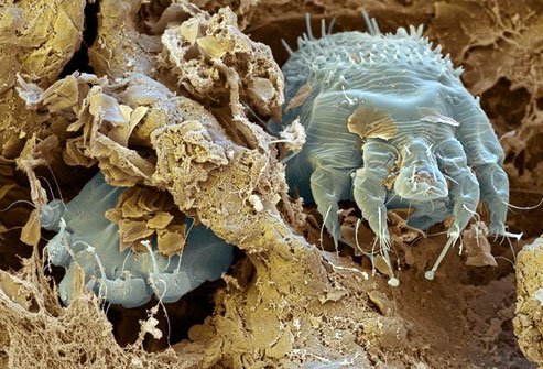 Scabies is an infestation of a highly contagious, microscopic skin parasite. Scabies are treated with scabicides that sometimes take more than one application to work. If itching and other symptoms continue more than four weeks after initial treatment, you should see a doctor. 
