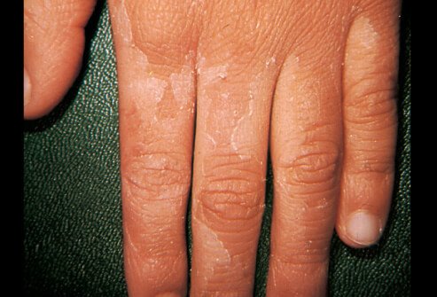 Picture of Scarlet Fever