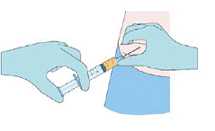 Anesthetize the area of
insertion (puncture) if deemed necessary and in consultation with the patient - Illustration