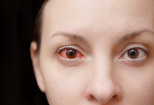 Inflammation of the white of the eye is a sign of scleritis.