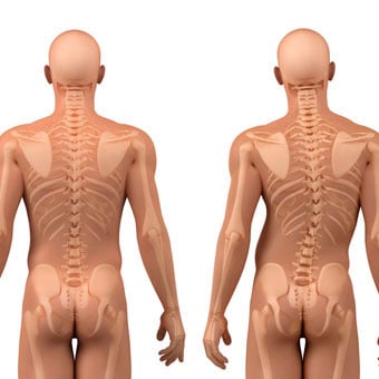 An illustration shows a healthy spine (left) and scoliosis spine curvature (right).