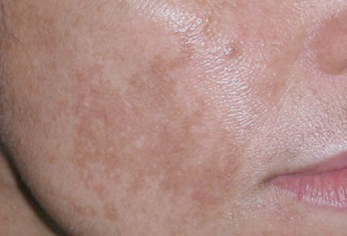 Photo of melasma.