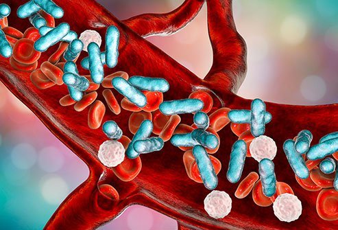 Prevention of infections and early diagnosis and treatment are the best ways to prevent sepsis or reduce the problems sepsis causes.