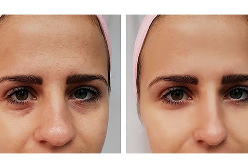 A septoplasty may correct and straighten a broken nose or deviated septum. 
