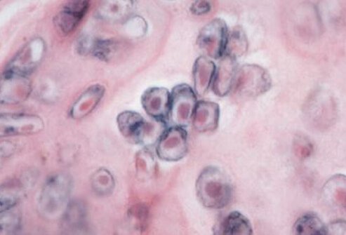 This is a magnification of the herpes-zoster virus, which causes shingles.