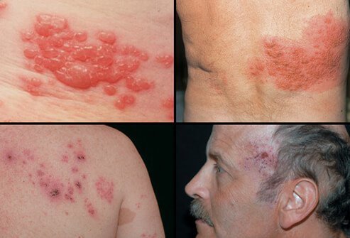 Herpes zoster results in a painful rash that may appear in one of several areas of the body.