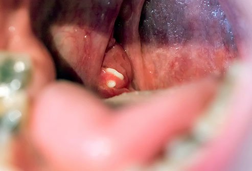 You can get rid of tonsil stones by gargling with saltwater, coughing to dislodge them, carefully dislodge them manually, or through medication or surgery. However, they will usually go away on their own with time.