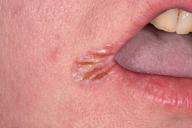 This starts as dry or irritated skin at one or both corners of your mouth and can turn into painful, bleeding sores.