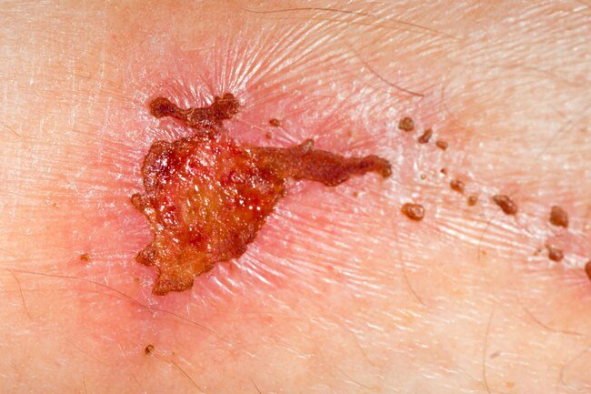 Insufficient protein intake may result in slower wound healing.